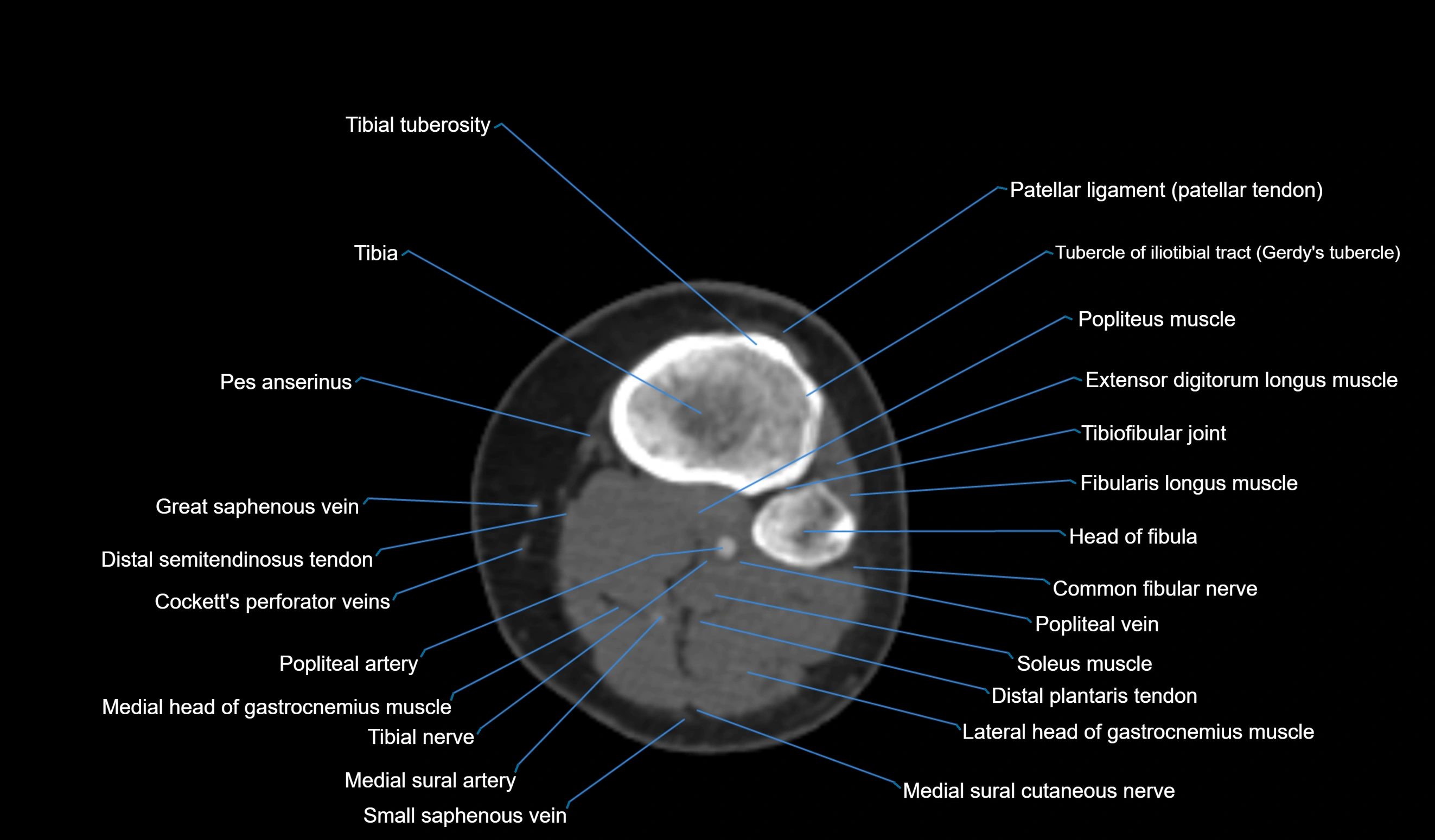 CT knee axial cross sectional anatomy labelled image-00046.webp